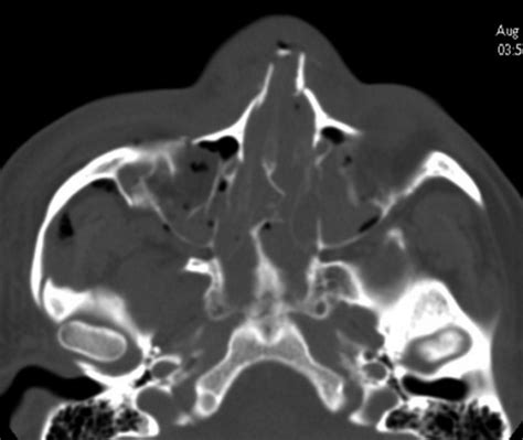 Cross sectional anatomy of paranasa 63. Axial CT scan. Multiple fractures of nasal bones, maxil ...