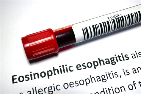 More About Eosinophilic Esophagitis Health Empowerment