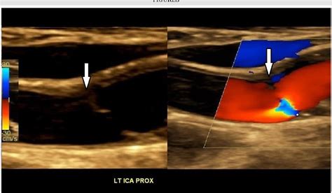 Internal Carotid Artery Ultrasound