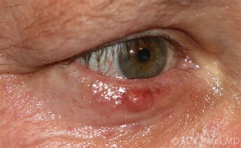Moran CORE What Are The Differences Between A Stye A Chalazion An