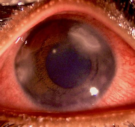 Immune Stromal Keratitis A Rare Ocular Presentation Of Tuberculosis