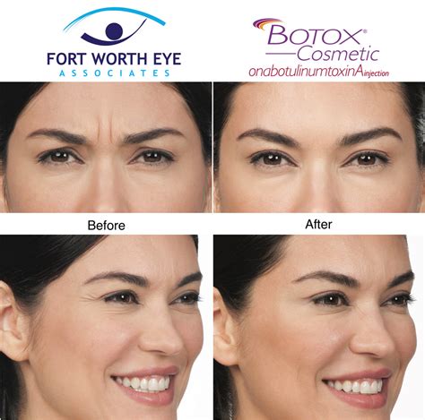 Nonsurgical Facial Cosmetic Procedures At Fort Worth Eye Associates