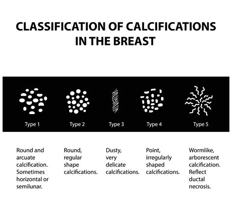 Your Guide To Understanding Breast Calcifications Fairfield Medical Center