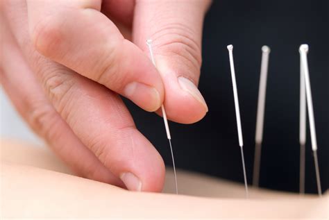 all you need to know about acupuncture and its benefits getcloudexplorer