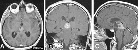 Pineal Region Germinoma In The Seventh Decade Case Report Barrow
