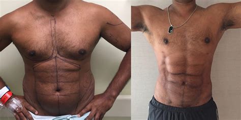 A Liposuction Procedure Promises 6 Pack Abs Without Lifting A Finger