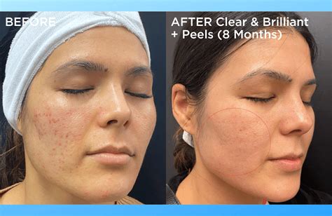 Clear Brilliant Laser Treatments Advanced Skin And Body Solutions