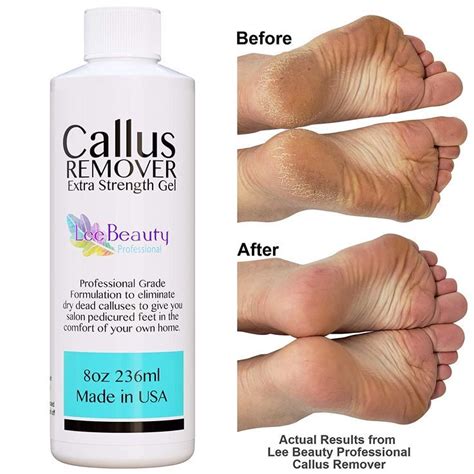 Lee Beauty Professional Callus Remover Extra Strength Gel For Feet At
