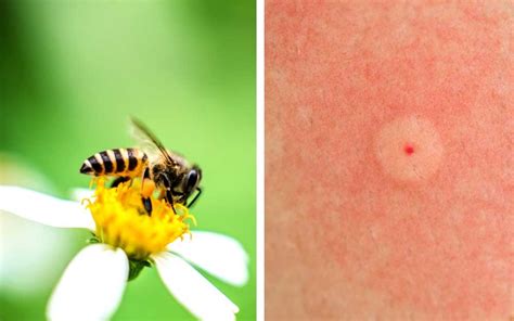 How To Identify These 9 Common Bug Bites Readers Digest