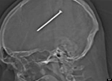 Amazing X Rays 3 Inch Nail In Chicago Man S Brain Latest Medical Wonder