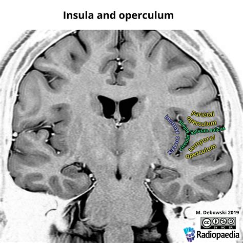Insula And Operculum Annotated Mri Image