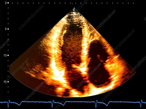 Normal Heart Ultrasound Scan Stock Image C0480784 Science Photo