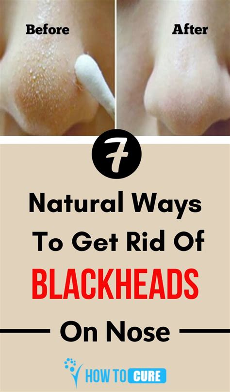7 Effective Home Remedies To Get Rid Of Blackheads On Nose At Home