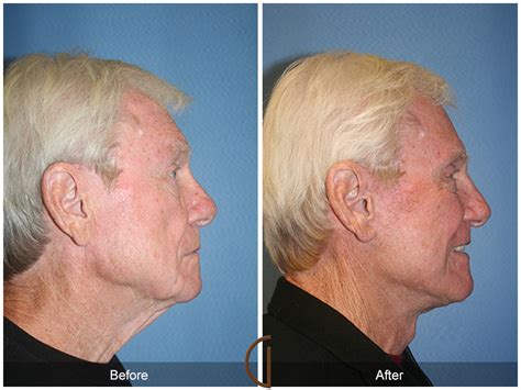 Neck Lift Before And After Photos Patient 111 Dr Kevin Sadati