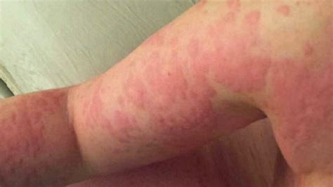 Moderna's vaccine is causing a rash on some people's arms after injection. Florida Woman Allergic to Own Sweat, Tears Details Her ...