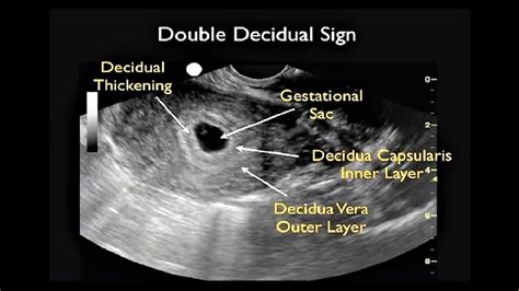 Ectopic Pregnancy Symptom Checker At Symptom