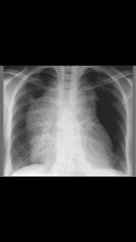 Mediastinal Widening Due To Anterior Mediastinal Mass In A Patient With