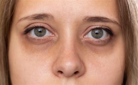 Dark Circles Causes And Solutions