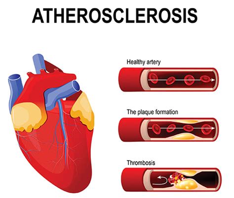 Atherosclerotic Vascular Disease East Cardiovascular Specialists