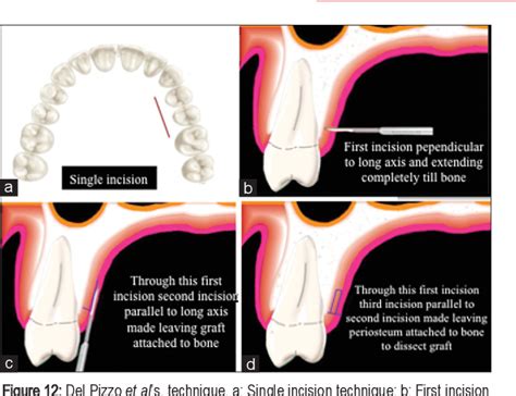 Year Journey Of Palatal Connective Tissue Graft Harvest A Narrative