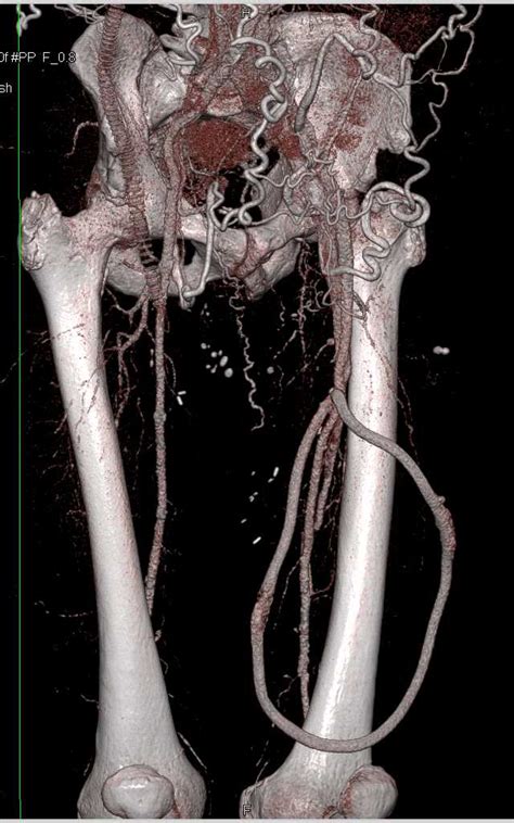 Arteriovenous Av Fistulae Left Thigh In A End Stage Renal Disease Esrd Patient Vascular