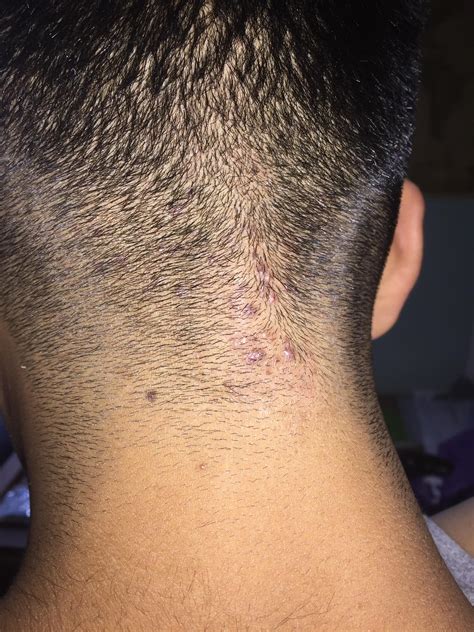 Hair Bumps On Back Of Neck