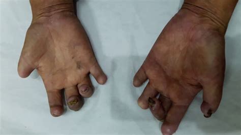 Systemic Sclerosis Hand Crest Syndrome Youtube