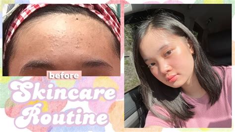 How To Get Rid Of Tiny Bumps On Forehead My Skincare Routine