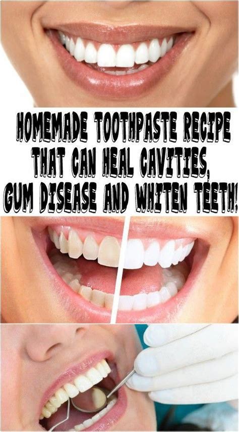 Mix baking soda, salt, and water together to make a paste. HOMEMADE TOOTHPASTE RECIPE THAT CAN HEAL CAVITIES, GUM ...