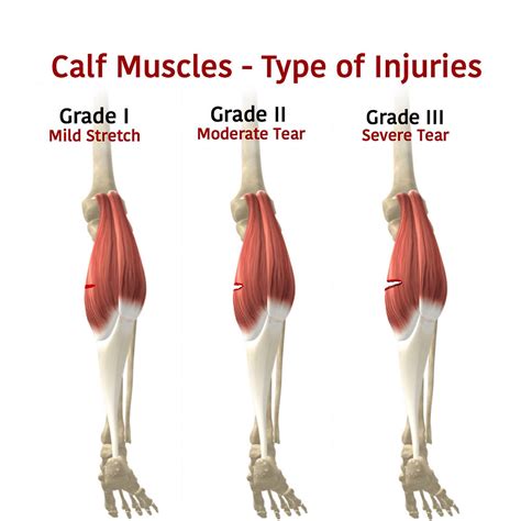 Calf Strain Motus Physical Therapy