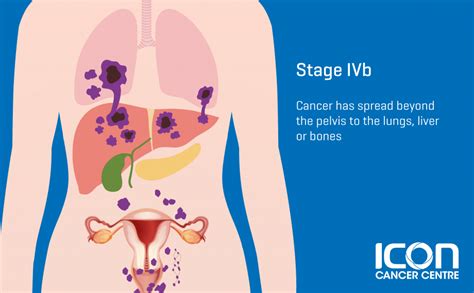 Cervical Cancer — Icon Cancer Centre Singapore