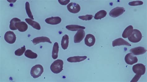 Sickle Cell Trait May Not Increase Risk Of Premature Death Study Finds