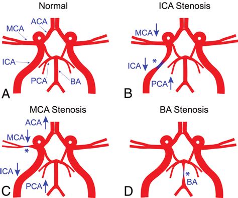 Schematic Cerebral Vascular Models A Normal B Ica Stenosis C Mca Download Scientific
