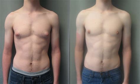 lynn lewis viral how much is gynecomastia surgery in canada