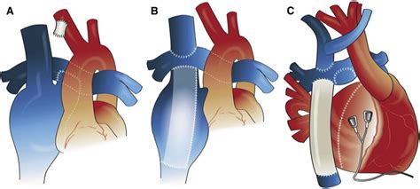 Variations Of The Fontan Operation A Modified Classic Right Atrium