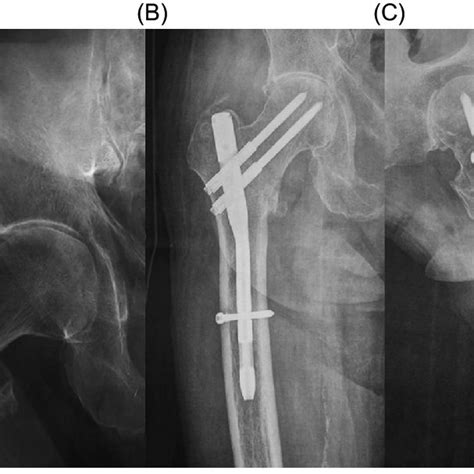 A Anteroposterior Radiograph Of The Right Hip Of A 75 Year Old Man