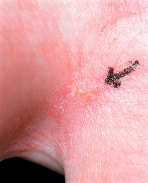 Scabies Diagnosis And Treatment The Bmj
