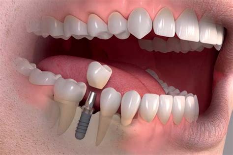 The Best Top 12 Dental Implant Brands A Patient Guide