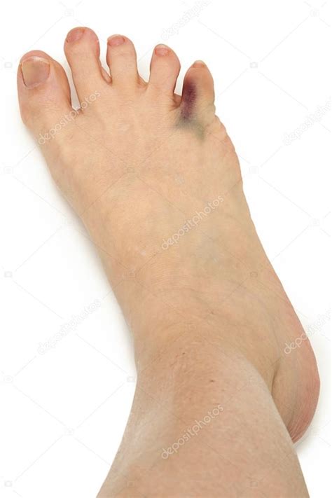 Broken Bruised Toe Over White — Stock Photo © Duplass 39792325