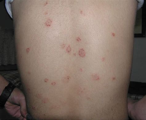 Pityriasis Rosea In Children Causes Symptoms Diagnosis And Treatment