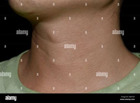 Neck Swelling Diagnosed As Hyperthyroidism Aging Skin Folds Or Skin