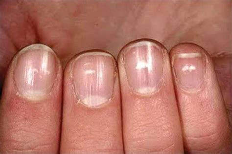 White Spots On Your Nails Here Is What They Indicate