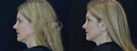 Kybella® Chin Sculpting The Dallas Center For Dermatology And Aesthetics