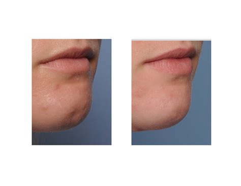 Fat Injections For Reducing The Appearance Of Chin Dimples Explore