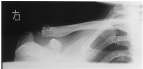 References In A Case Of Post Traumatic Osteolysis Of The Distal