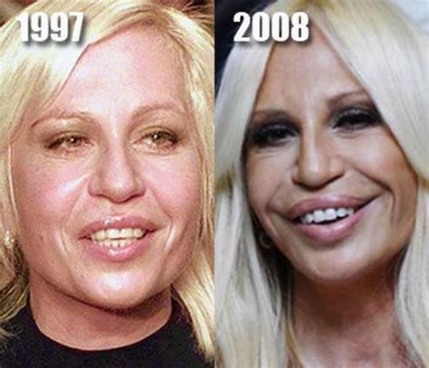The Story Of Donatella Versace Plastic Surgery Disaster