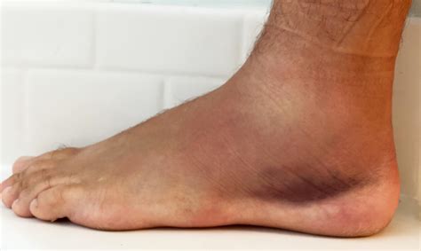 What Is An Inversion Ankle Sprain And What Are Its Ca