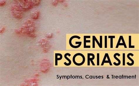 Genital Psoriasis Symptoms Causes And Treatment