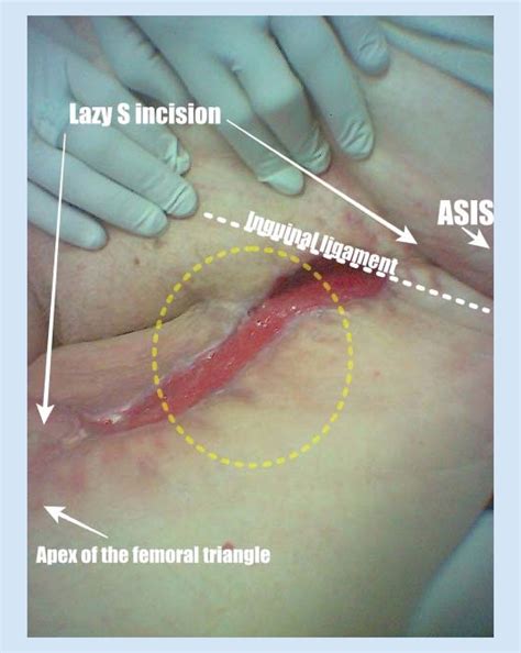 Laparoscopically Assisted Ilio Inguinal Lymph Node Dissection Versus