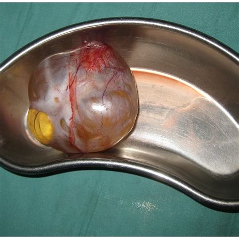 Mesenteric Dermoid Cyst After Removal Download Scientific Diagram